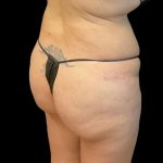 Brazilian Butt Lift Before & After Patient #8554