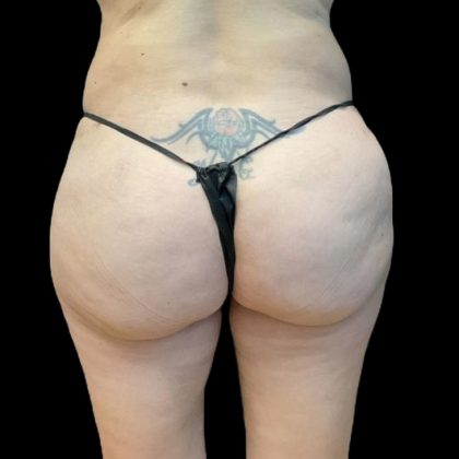 Brazilian Butt Lift Before & After Patient #8554