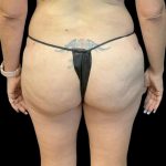 Brazilian Butt Lift Before & After Patient #8554