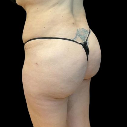 Brazilian Butt Lift Before & After Patient #8554