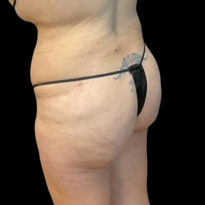 Brazilian Butt Lift Before & After Patient #8554