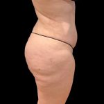 Brazilian Butt Lift Before & After Patient #9177