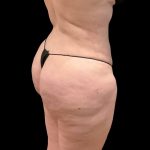 Brazilian Butt Lift Before & After Patient #9177
