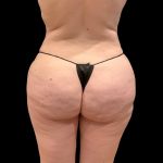 Brazilian Butt Lift Before & After Patient #9177