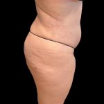 Brazilian Butt Lift Before & After Patient #9177