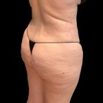 Brazilian Butt Lift Before & After Patient #9177