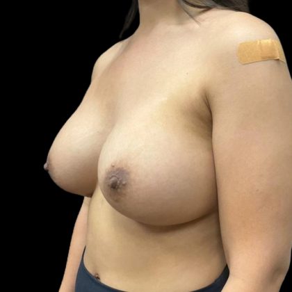 Breast Augmentation Before & After Patient #8045