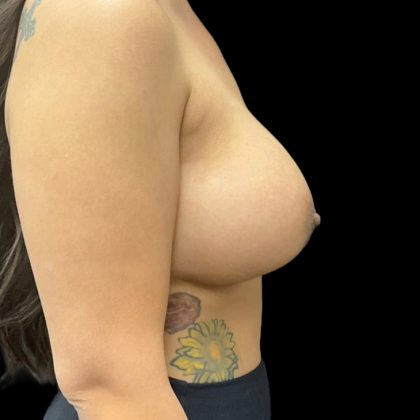 Breast Augmentation Before & After Patient #8045