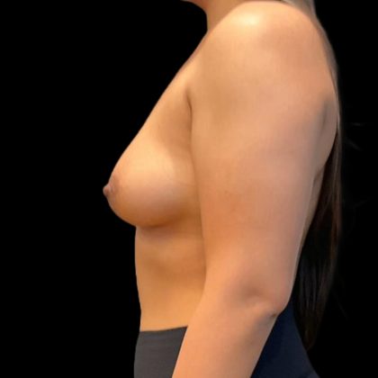 Breast Augmentation Before & After Patient #8045