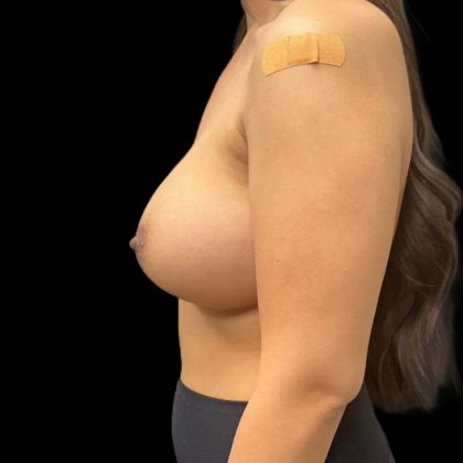 Breast Augmentation Before & After Patient #8045