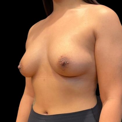 Breast Augmentation Before & After Patient #8045