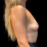 Breast Augmentation Before & After Patient #9060