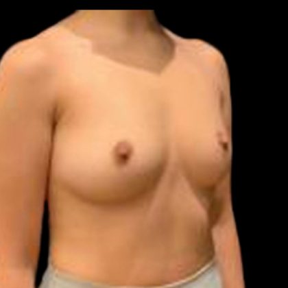 Breast Augmentation Before & After Patient #5450