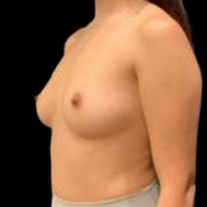 Breast Augmentation Before & After Patient #5450