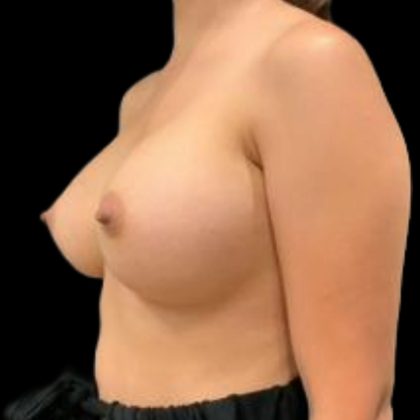 Breast Augmentation Before & After Patient #5450