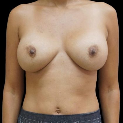 Breast Implant Exchange Before & After Patient #6728