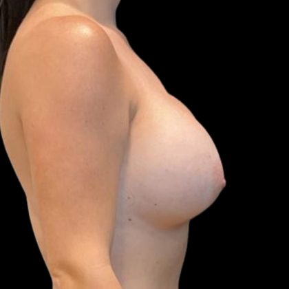 Breast Implant Exchange Before & After Patient #8174