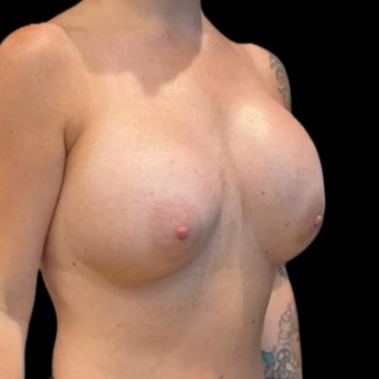 Breast Implant Exchange Before & After Patient #8174
