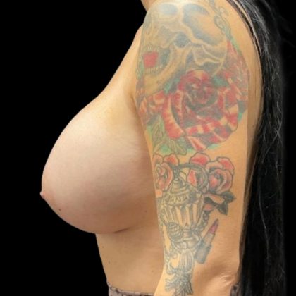 Breast Implant Exchange Before & After Patient #8174