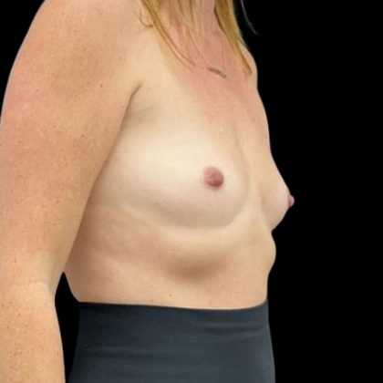 Breast Augmentation Before & After Patient #8044