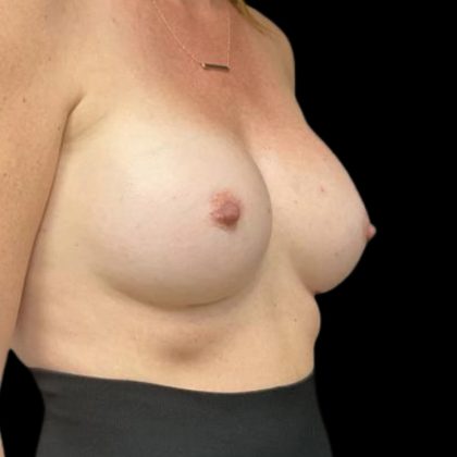 Breast Augmentation Before & After Patient #8044