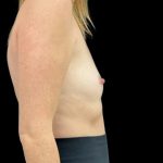 Breast Augmentation Before & After Patient #8044