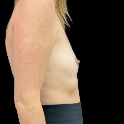 Breast Augmentation Before & After Patient #8044