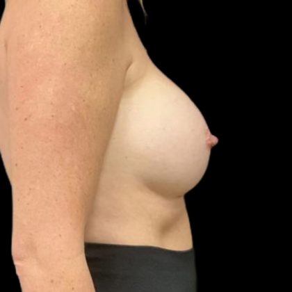 Breast Augmentation Before & After Patient #8044