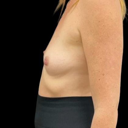 Breast Augmentation Before & After Patient #8044