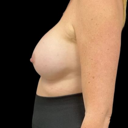 Breast Augmentation Before & After Patient #8044