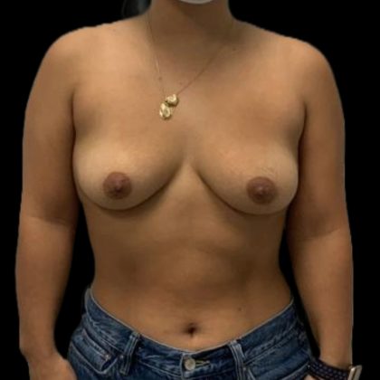 Breast Augmentation Before & After Patient #8049