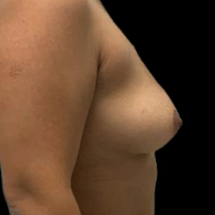 Breast Augmentation Before & After Patient #8049