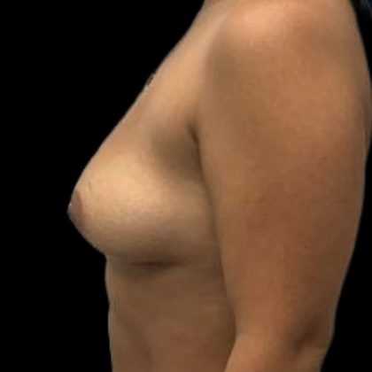 Breast Augmentation Before & After Patient #8049