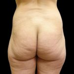 Butt Implants Before & After Patient #6841