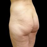Butt Implants Before & After Patient #6841