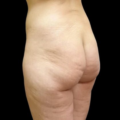 Butt Implants Before & After Patient #6841