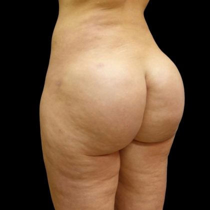 Butt Implants Before & After Patient #6841