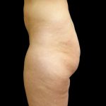 Butt Implants Before & After Patient #6841