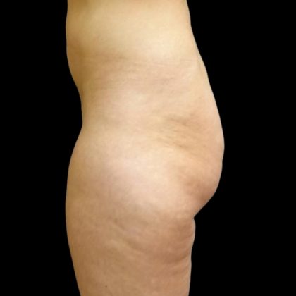 Butt Implants Before & After Patient #6841