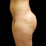 Butt Implants Before & After Patient #6841
