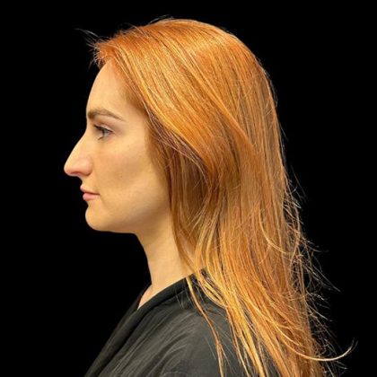 Rhinoplasty Before & After Patient #9602