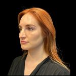 Rhinoplasty Before & After Patient #9602
