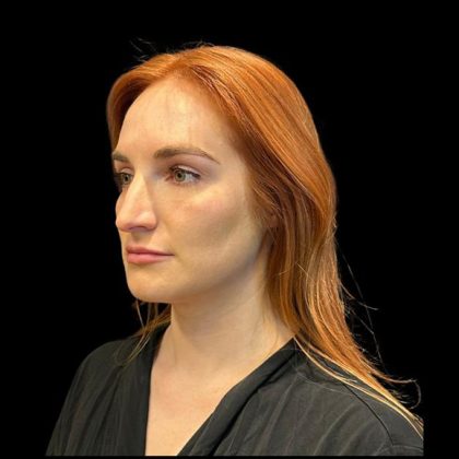 Rhinoplasty Before & After Patient #9602