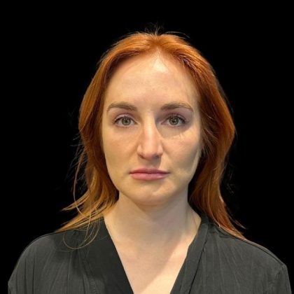 Rhinoplasty Before & After Patient #9602