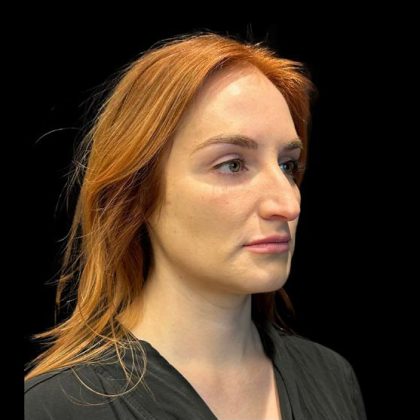 Rhinoplasty Before & After Patient #9602