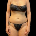 High Definition Liposuction Before & After Patient #5558