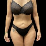 High Definition Liposuction Before & After Patient #5558