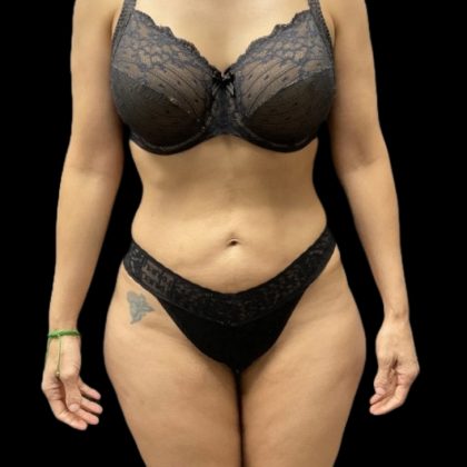 High Definition Liposuction Before & After Patient #5558