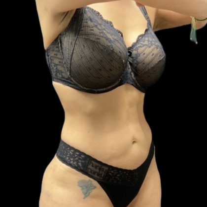High Definition Liposuction Before & After Patient #5558