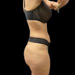 High Definition Liposuction Before & After Patient #5558